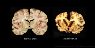 Slides of CTE Damaged Brain Samples